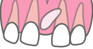 過剰歯