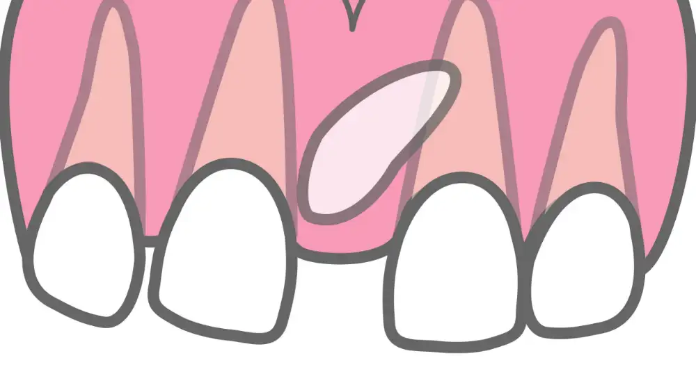 過剰歯