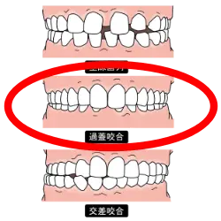 過蓋咬合
