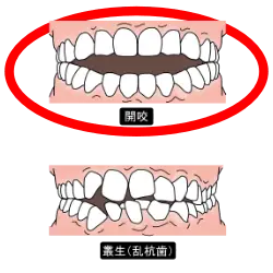 開咬