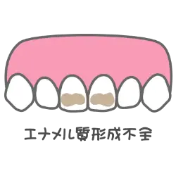 エナメル質形成不全